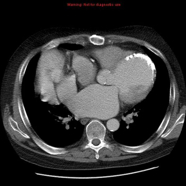 File:CT Heterotopic heart transplantation.jpg