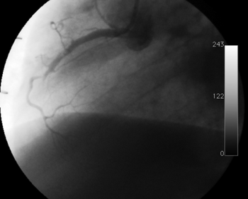 Occlusion of the right coronary artery 2 years after heart transplantation.