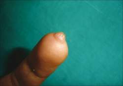 Angiofibroma at fingertip (acquired fibrokeratoma)