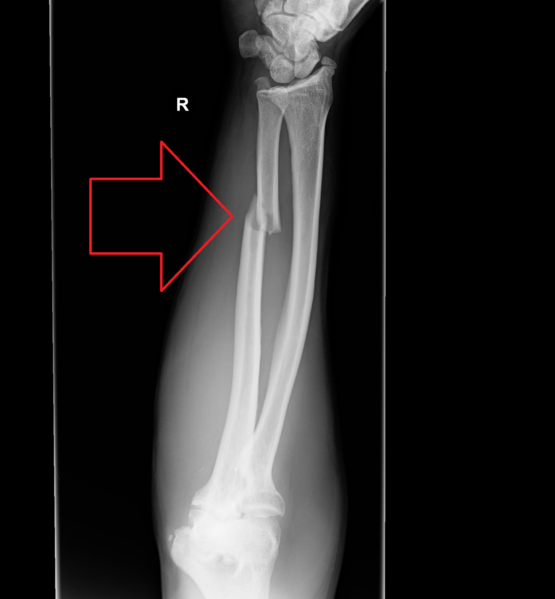 File:Nightstick-fracture-1.png