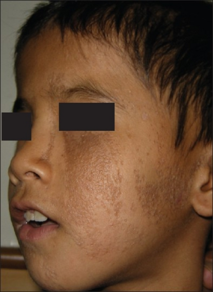 File:Nevus comedonicus syndrome.png