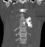 Osteoblastoma-cervical-spine.jpg