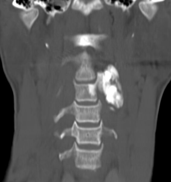File:Osteoblastoma-cervical-spine.jpg