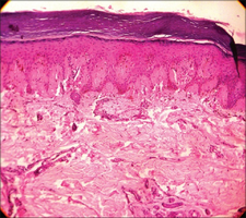Laugier-Hunziker Syndrome histology.png