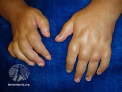 Swollen fingers due to psoriatic arthritis[7]