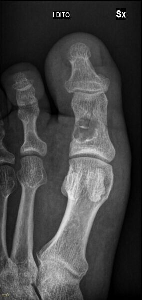 File:Unicameral-bone-cyst-of-the-big-toe.jpg