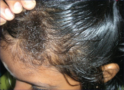 Woolly hair nevus 4.png