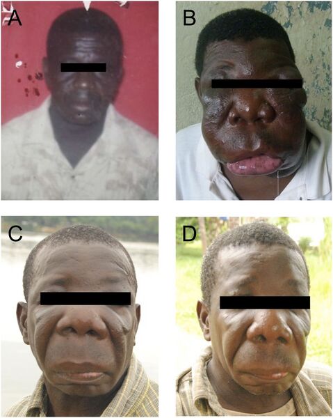 File:Conidiobolomycosis- before, during and after treatment.jpg