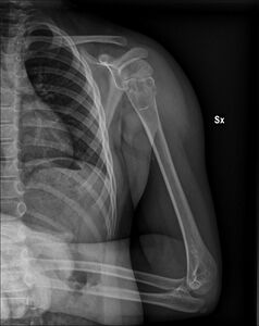 Unprovoked break in the long bone of the upper arm,, with "fallen leaf" sign.