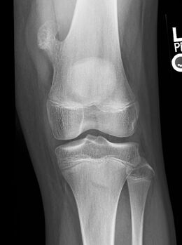 Osteochondroma arising from the thigh bone, near the knee