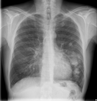 Chest X-ray of lungs affected by cryptococcosis