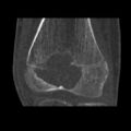 1. b. CT scan shows chondroblastoma of thigh bone near knee more clearly