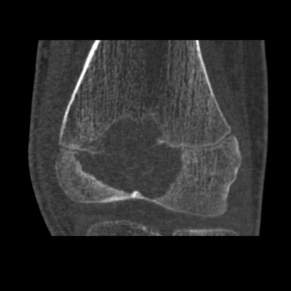 File:Chondroblastoma-distal-femur-2-2.jpg
