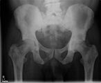 X-ray: Bone cancer in hip, spread from prostate cancer.