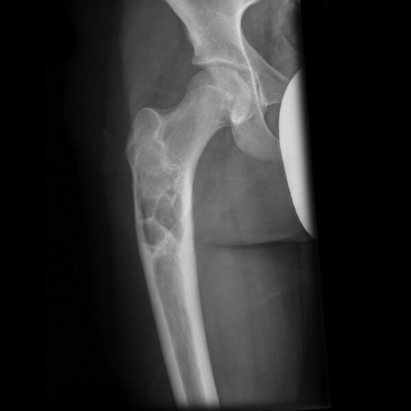 File:Unicameral-bone-cyst-femur-3.jpg