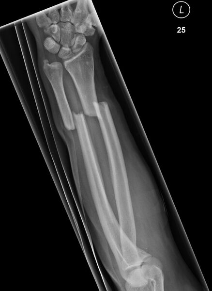 File:Midshaft-fractures-of-the-radius-and-ulna.jpg