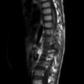 MRI scan osteoblastoma spine
