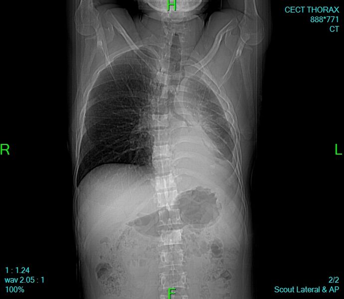 File:Bone-metastases-from-lung-carcinoma.jpg