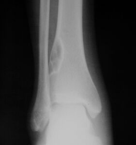 1. a. Front view X-ray: NOF of the lower leg bone near ankle, with well-defined tumor